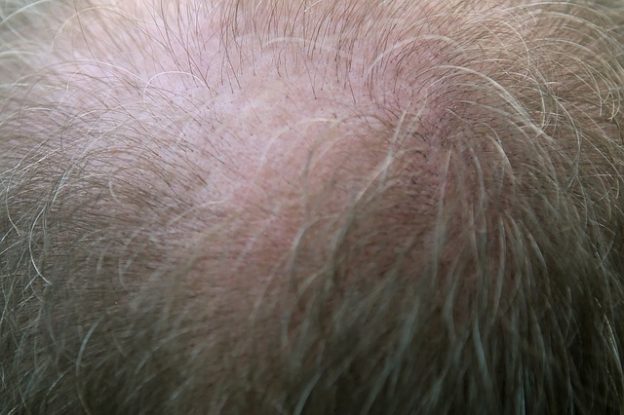 Enzym gegen Haarausfall